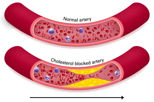 A normal artery beside one narrowed by cholesterol